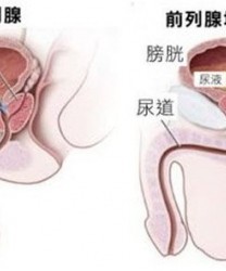 前列腺增生的晚期有哪些常见症状