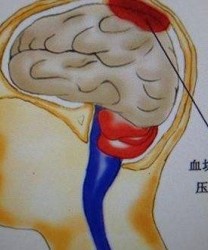 脑血栓的原因和解决方法