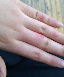 冻疮早期有哪些常见症状