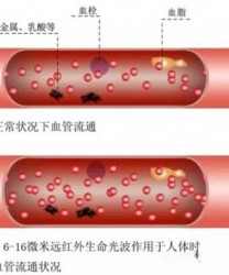 心脑血管病的预防措施有哪些